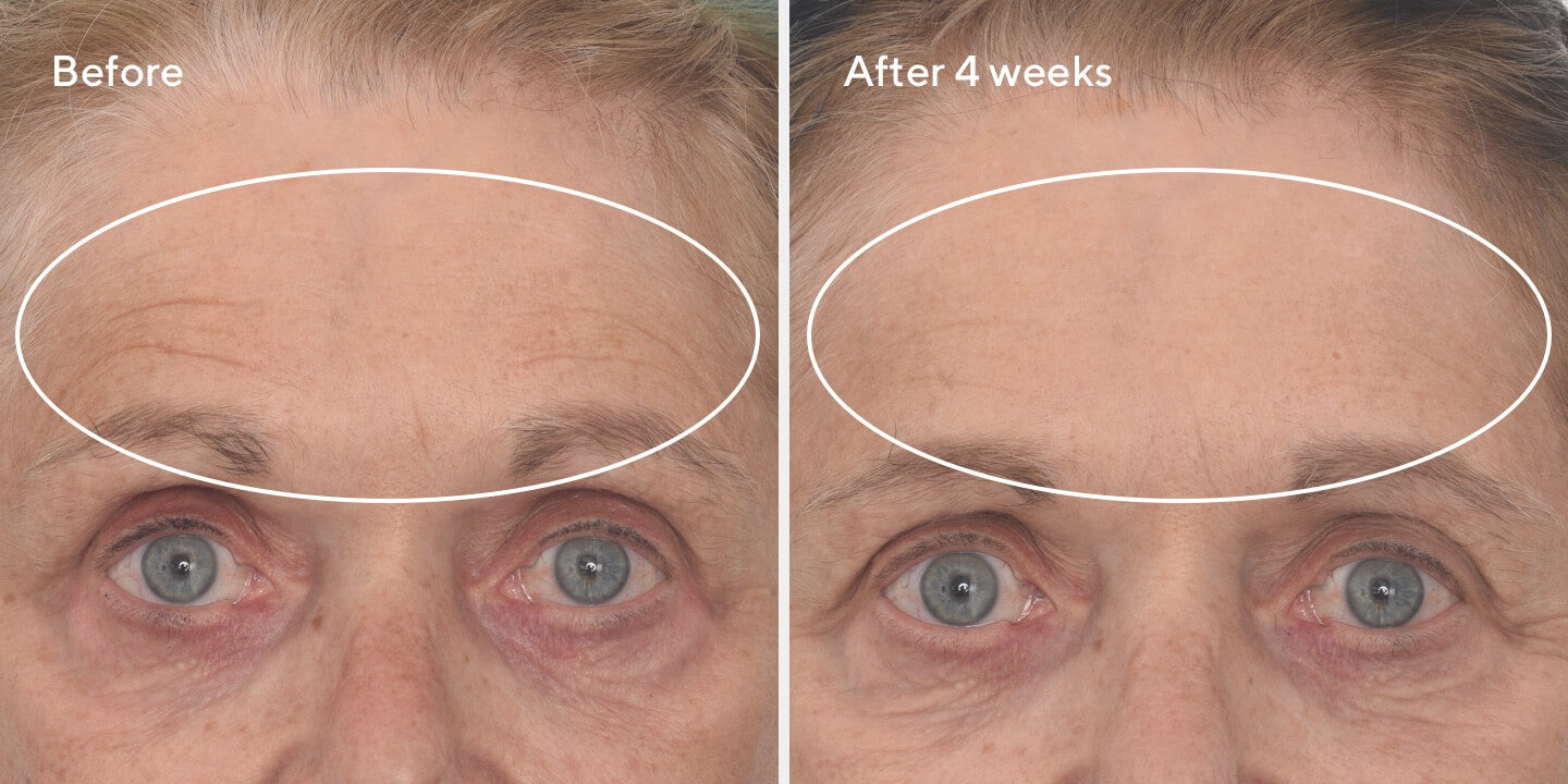 Retinal ReSculpt™ Overnight Treatment B&A 2