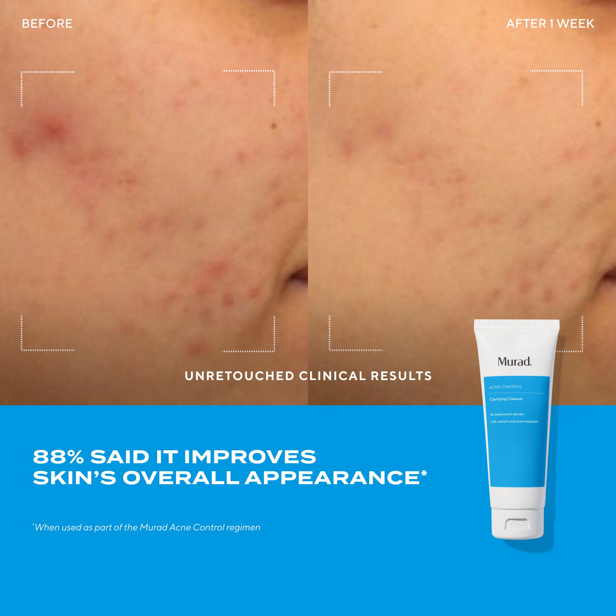 Nettoyant clarifiant anti-acné