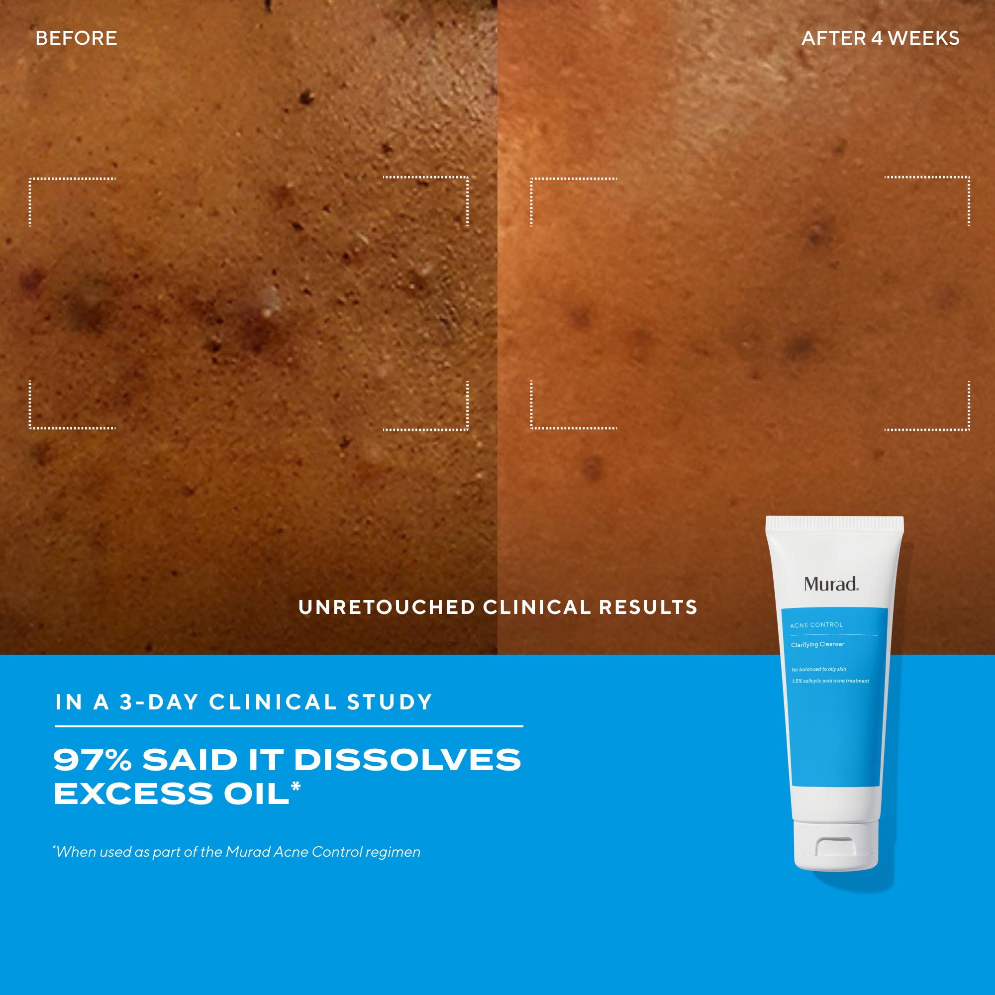 Nettoyant clarifiant anti-acné