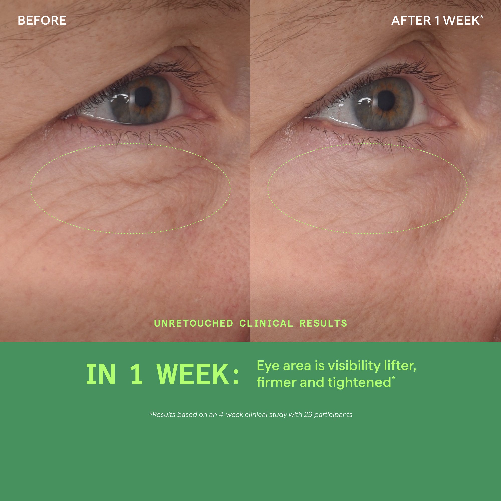 Traitement de lifting des yeux Retinal ReSculpt