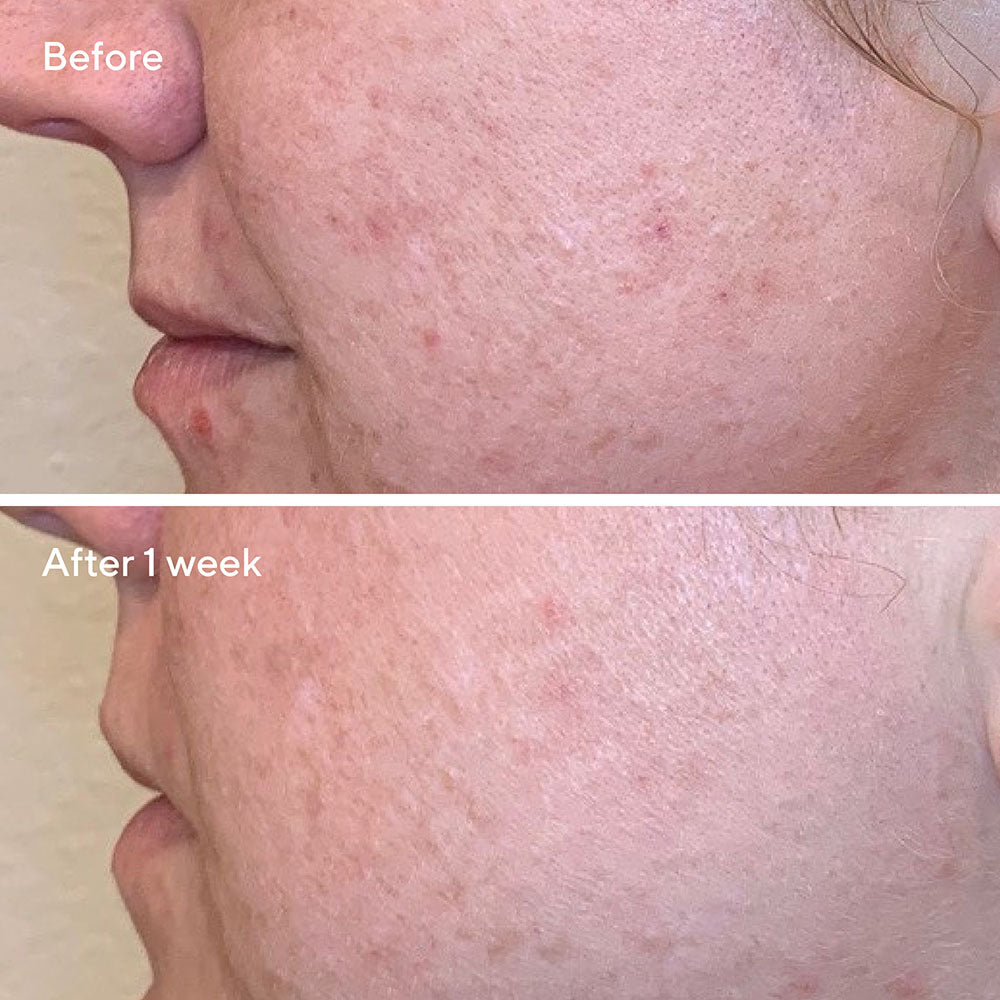 Peeling Clarifiant Quotidien AHA/BHA/Rétinoïdes 