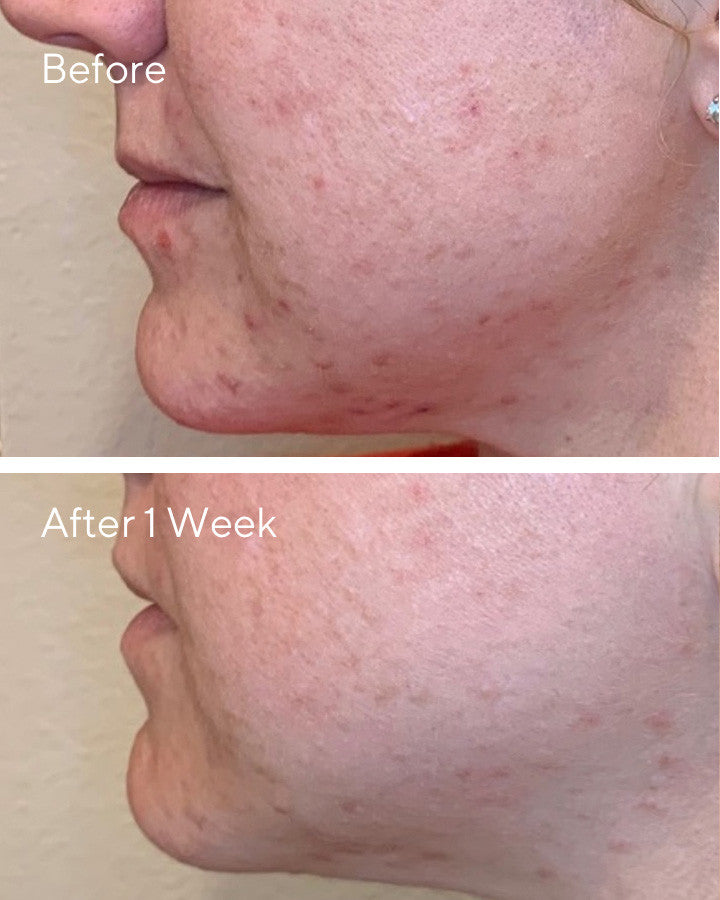 Daily Clarifying Peel - B&A