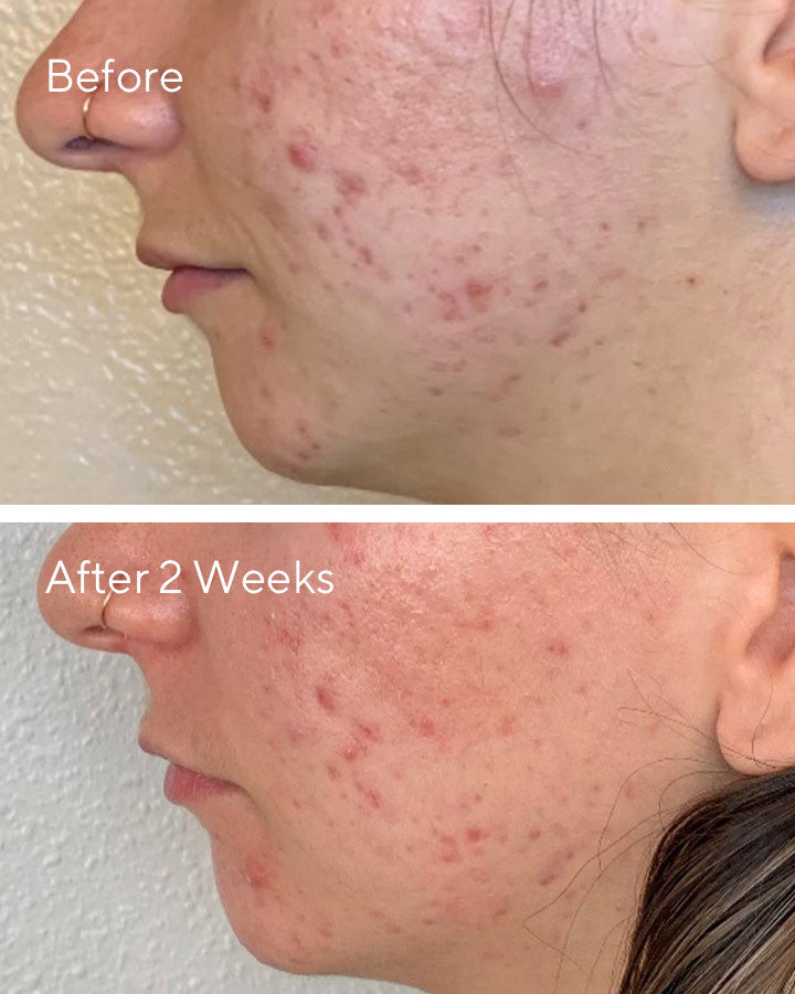 Daily Clarifying Peel - B&A